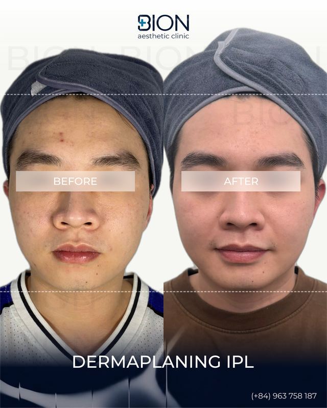 Before and after treatment: Dermaplaning IPL 1