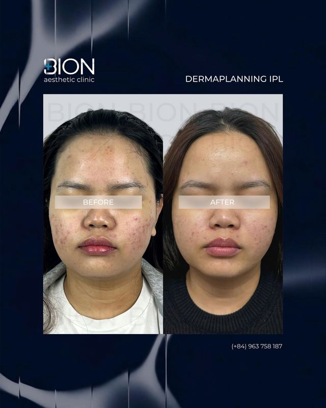 Before and after treatment: Dermaplaning IPL 2