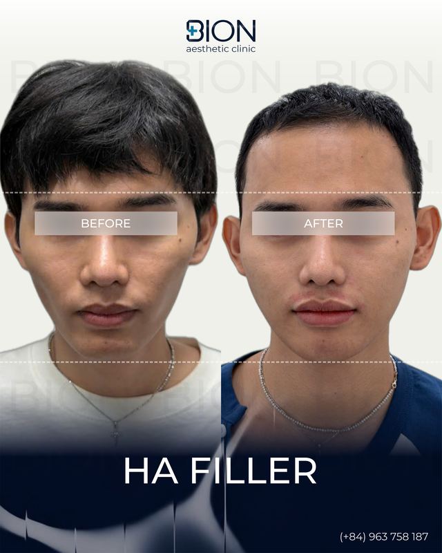 Filler 3