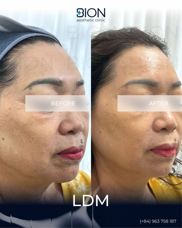 LDM (Local Dynamic Micro-massage) 2