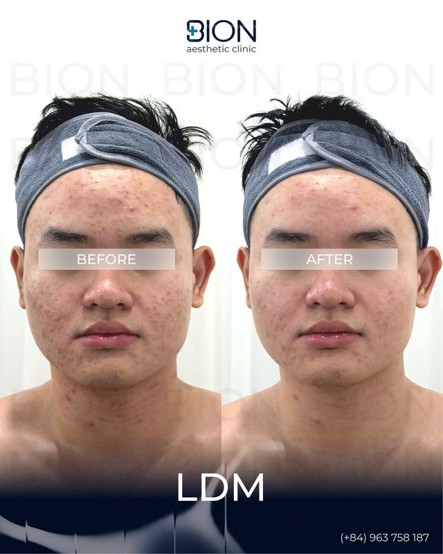 LDM (Local Dynamic Micro-massage) 3