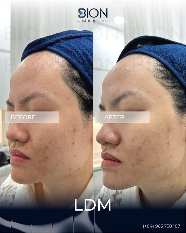 Before and after treatment: LDM 4