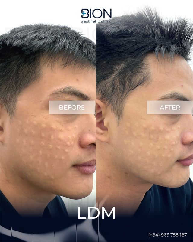 Before and after treatment: LDM 5