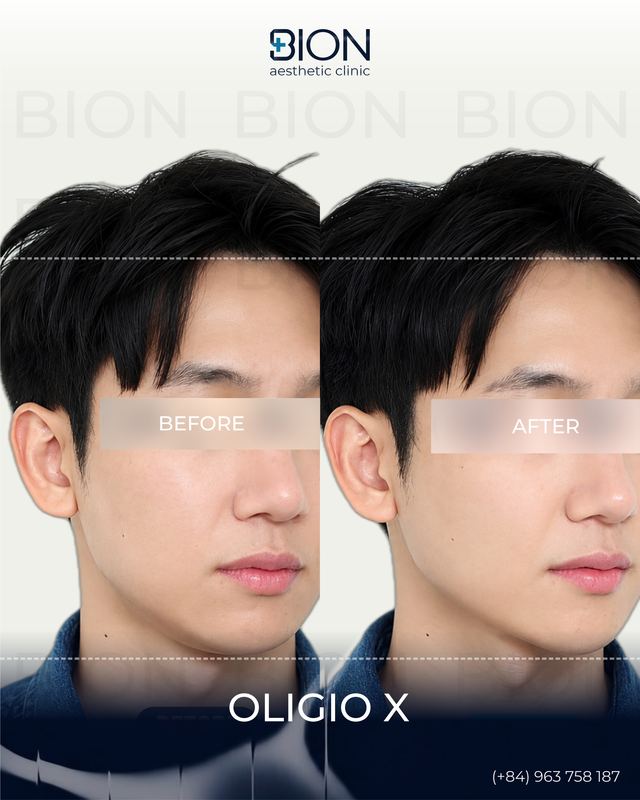 Before and after treatment: Oligio X 1
