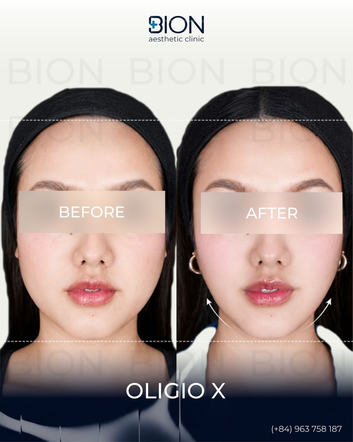 Trước và sau điều trị Oligio X, khách hàng 2