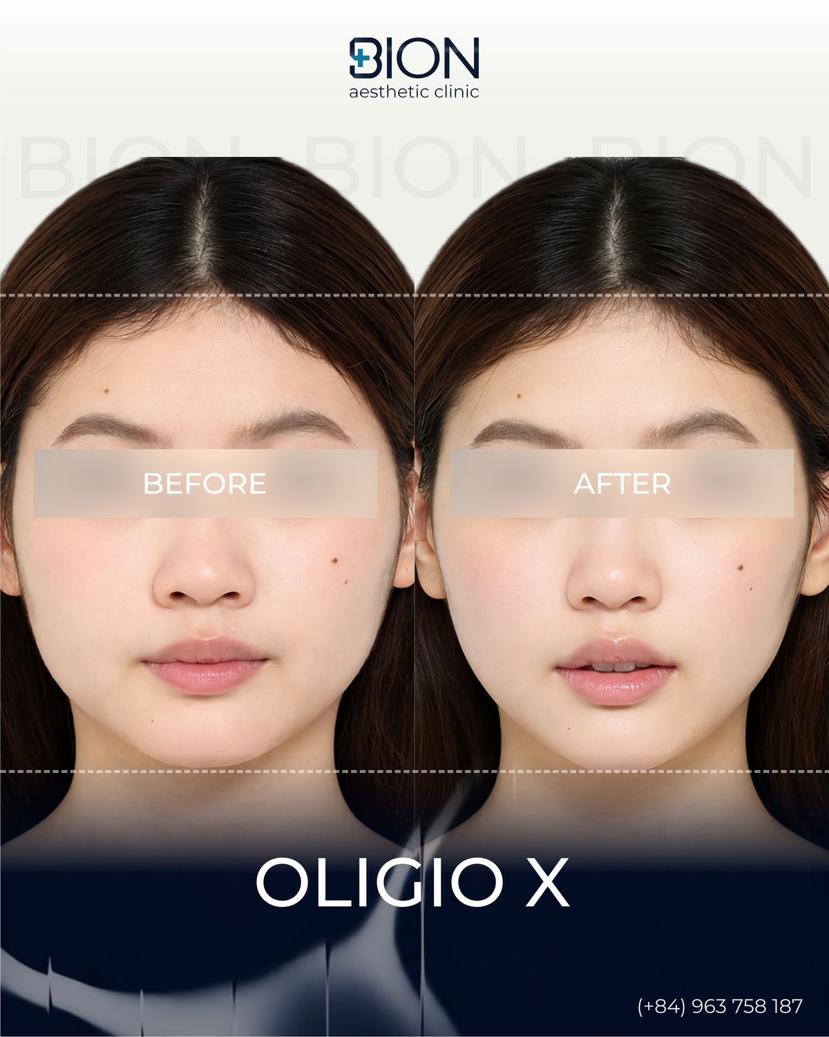 Trước và sau điều trị Oligio X, khách hàng 3