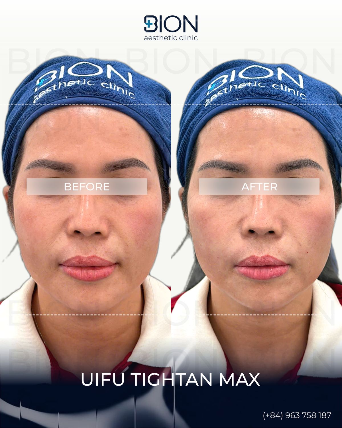 Trước và sau điều trị UIFU Tightan Max, khách hàng 1