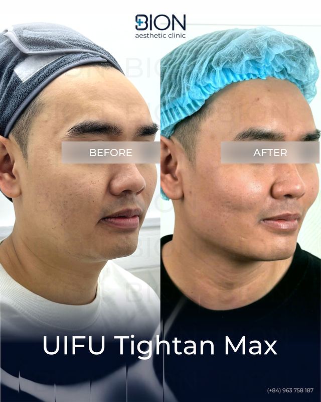 Before and after treatment: UIFU Tightan Max 2