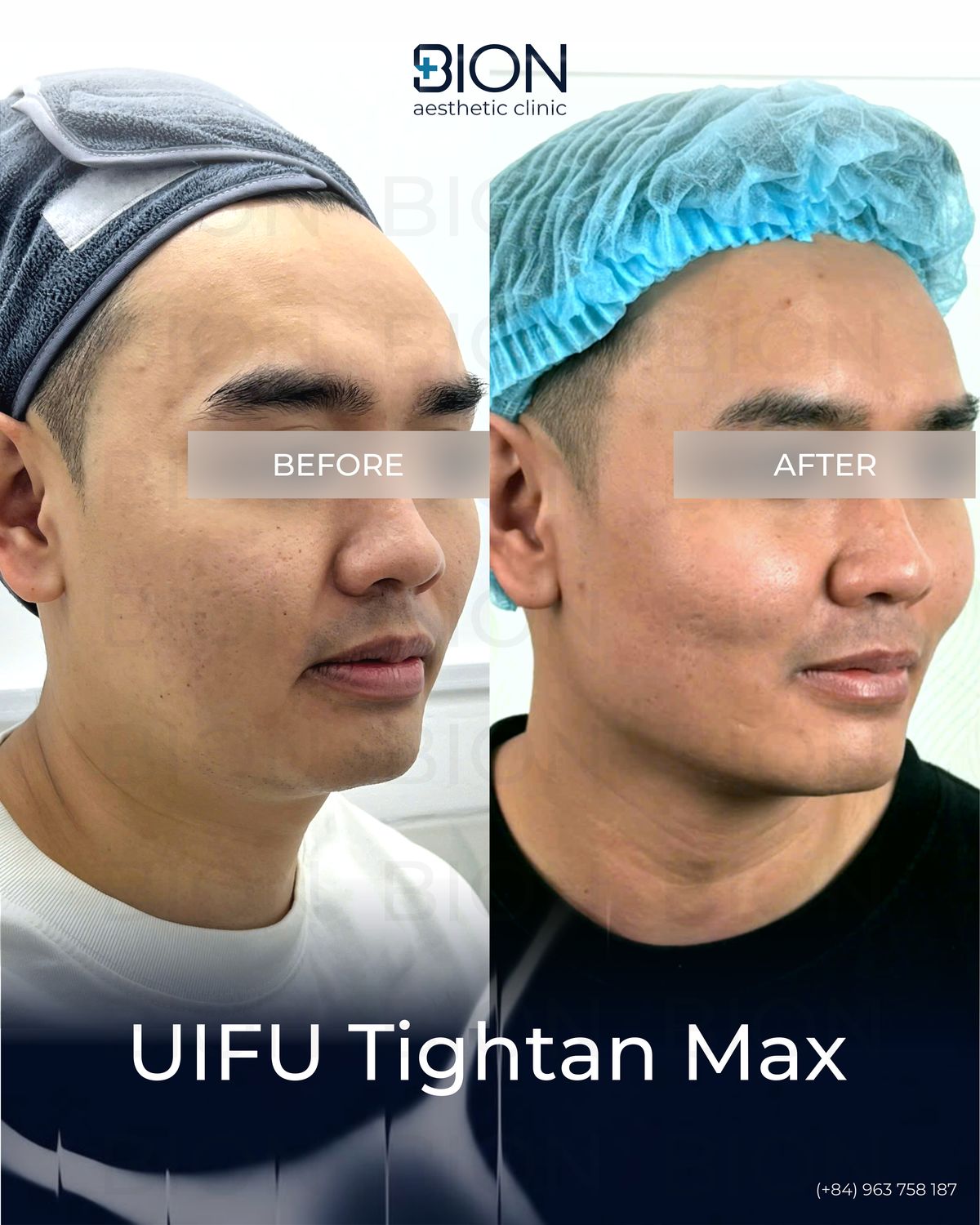 Trước và sau điều trị UIFU Tightan Max, khách hàng 2