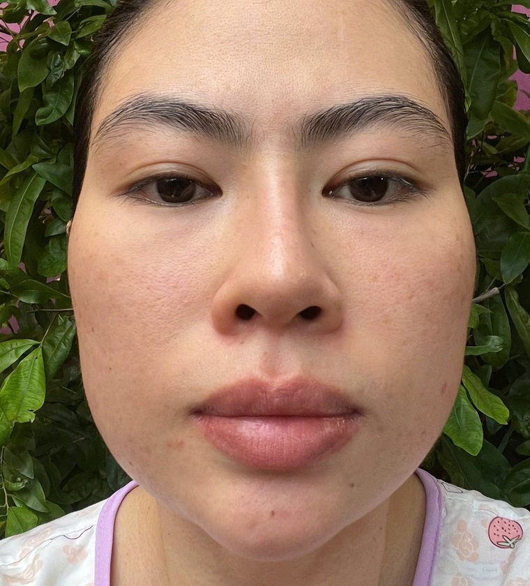 After: Inflamed acne and post-inflammatory pigmentation